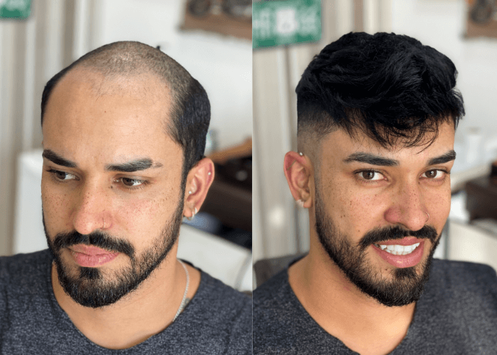 Roots Care client before and after a custom non-surgical hair replacement system