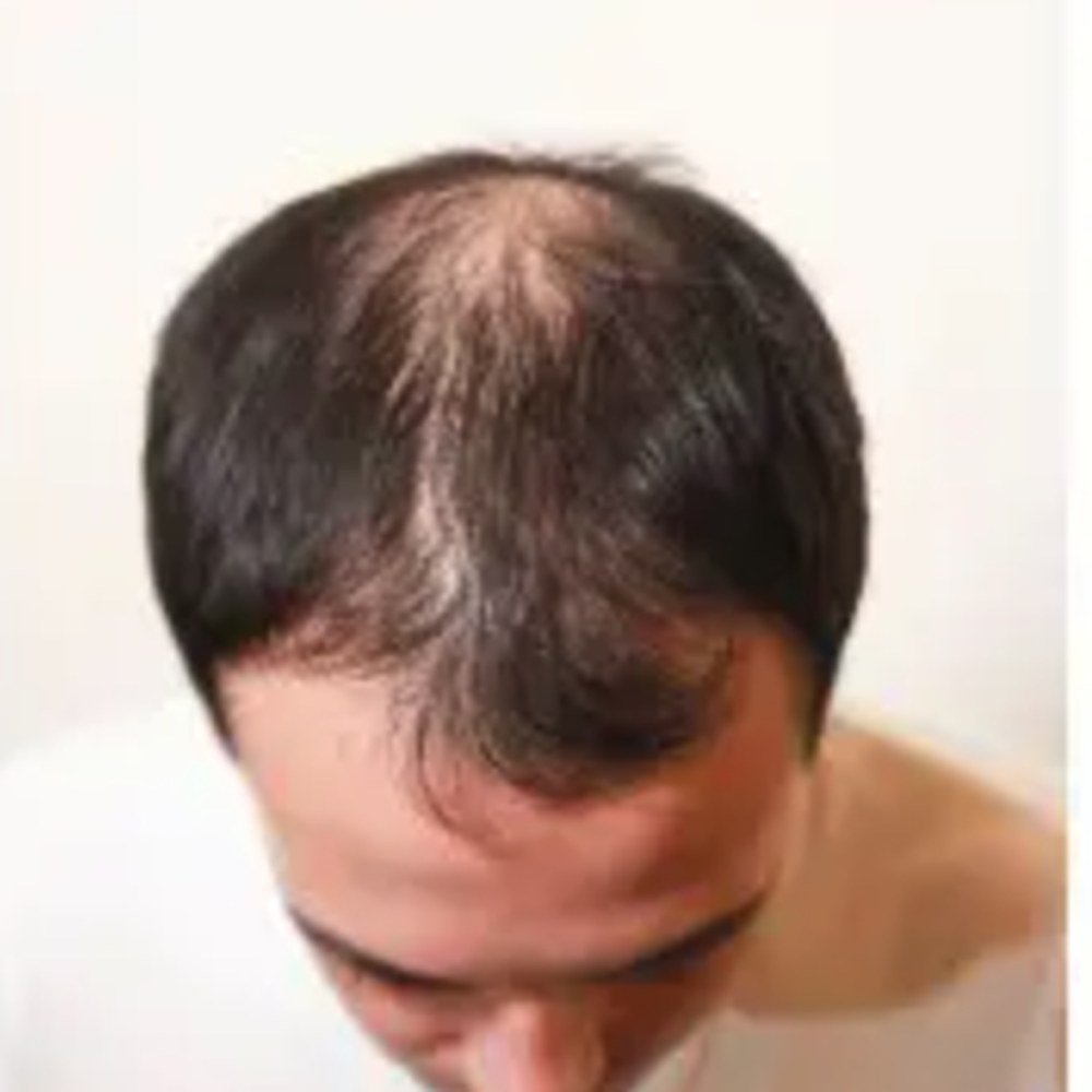 Roots Care client before: Crown density restored with a custom hair system