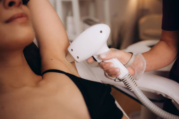 OPT hair removal treatment at Roots Care