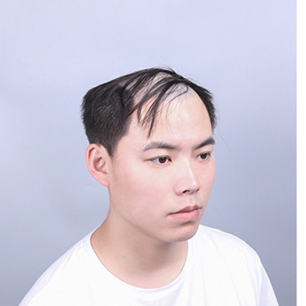 Roots Care client before: Receding hairline rebuilt for a natural front