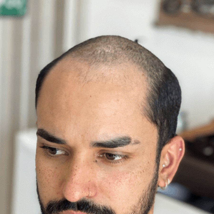 Roots Care client before: Hair Replacement System — City Gate Studio