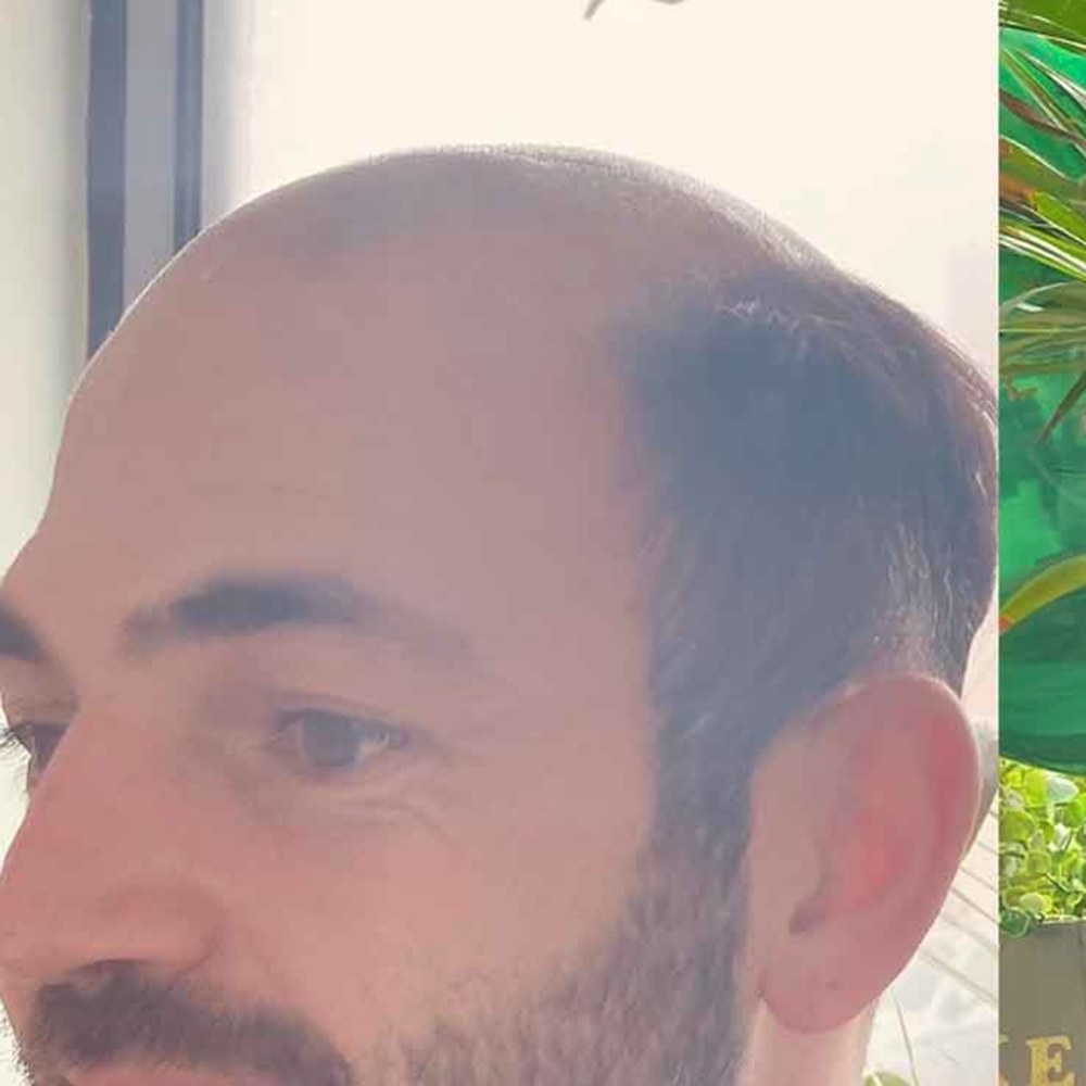 Roots Care client before: Full hair system, natural hairline