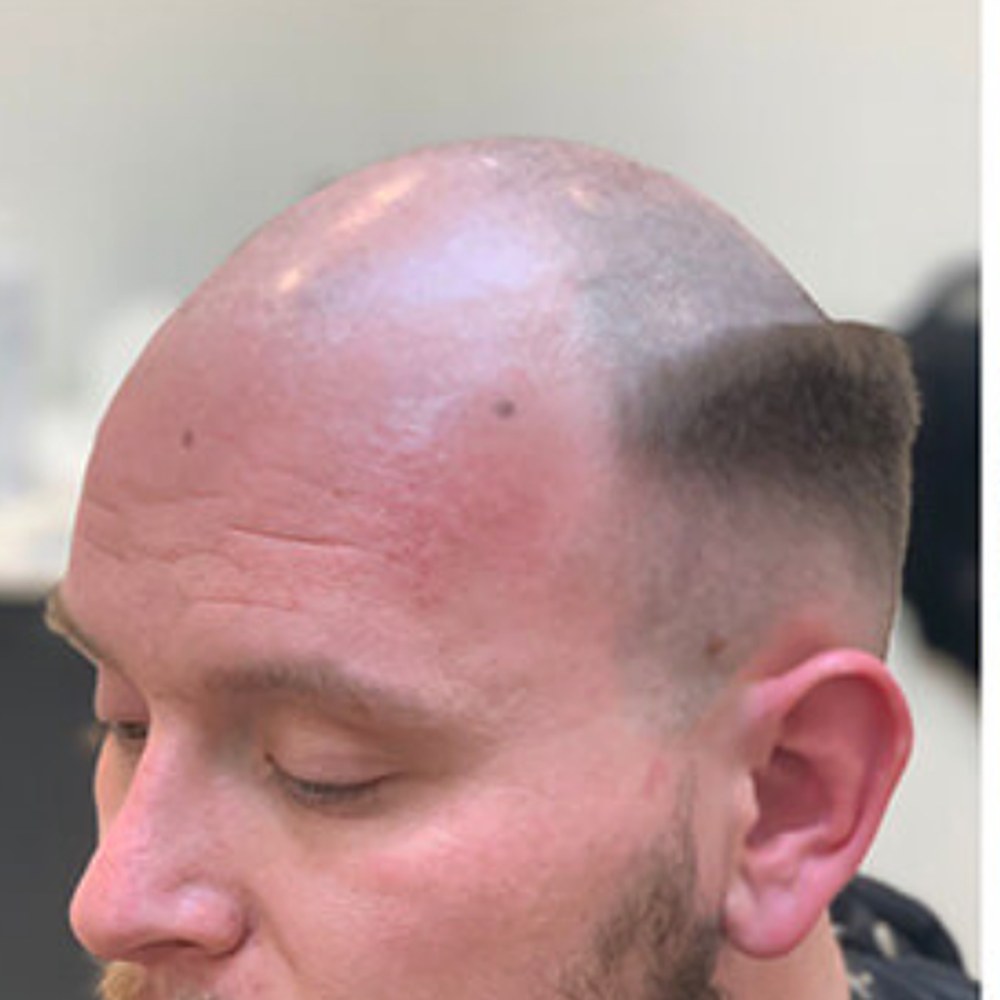 Roots Care client before: Crown coverage with textured styling